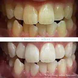 ㊗️1周年記念キャンペーン🎉8分×2回照射💡セルフホワイトニング6,600円→1,580円🫧2倍効果パープルライト