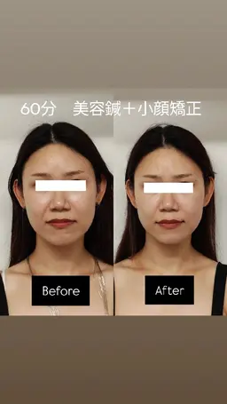 【人気No.1】オーダーメイド美容鍼コース＋選べる1種手技＋韓国式LED美顔器　60分