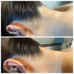 初回女性背中＆うなじ脱毛　¥3800 【口コミ必須】