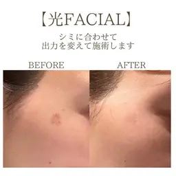 【本気の肌管理】光×RF×超音波×シミケア×氷結★本気で肌を変えたい方へ！シミ・たるみ・エイジングケア徹底攻略✨