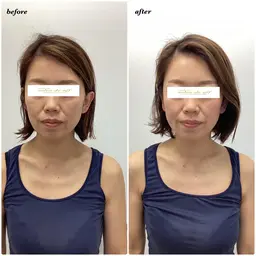 【🌷初回限定🌷】小顔矯正+ドライヘッドスパ(30分)