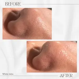 【韓国肌パック仕上げ/鎮静・改善】毛穴洗浄🫧ハイドロフェイシャル1回