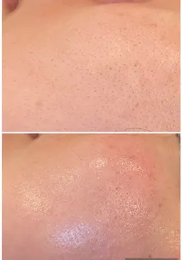 🉐 毛穴の黒ずみ・開きに ソフトダーマ+水素洗浄で陶器肌へ