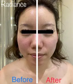 【超絶小顔コース】💆‍♀️毛穴洗浄・リンパ流し・超小顔パック・極上保湿で毛穴引き締め驚きの肌質へ🌟