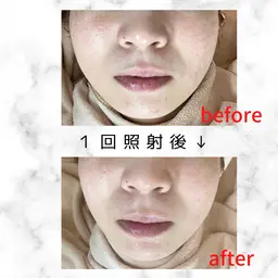 【顔】NPL方式 光フォト〈クレンジング+超音波角質洗浄+光フォト+シートマスク〉光フェイシャル 新規or会員