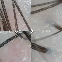 👀頭皮スコープ&ハイドラ毛穴洗浄✨　15分