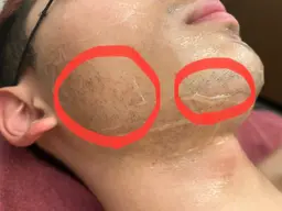 【メンズ】ひげ脱毛🥸