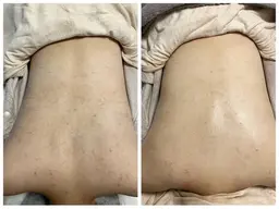 肌質改善ハーブトリートメント🌿【国産ハーブ✖️ドクターズライン】肌タイプを選ばない【お背中】上半分or下半分