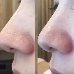 【毛穴汚れ✖︎いちご鼻撃退】ハイドラ毛穴洗浄お試し