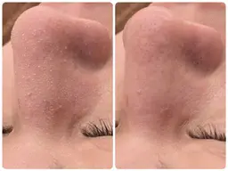 【ごっそり毛穴ケア】周南市初上陸！韓国式3D毛穴洗浄