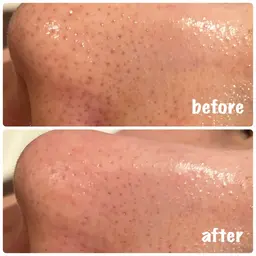 【口コミ価格】※先着10名‼︎ お肌が潤うハイドラフェイシャル(毛穴洗浄)×管理栄養士による食事カウンセリング付