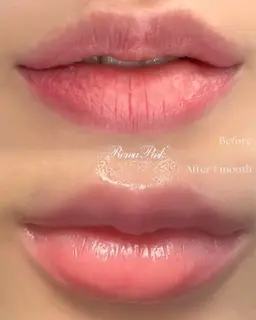 💋ローマピンクカウンセリング💋最新技術で気になる黒ずみを1回で赤ちゃんピンクいろへ🎀