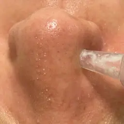 韓国式毛穴洗浄・光フェイシャル（小鼻のみ）