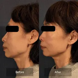 【40代以上限定】ほうれい線、たるみ、シワ、ハリ！✨田中みな実絶賛✨の炭酸ガスパック付フェイシャルメニュー✨