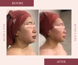 二重あごもたつき撃退！Redショット＆小顔リフト