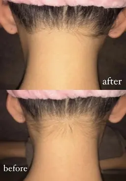 【お試し価格】えりあし・うなじ脱毛通常¥4,950→¥1,650