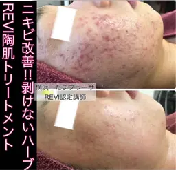 水光肌仕上げ⭐️ミニモ限定⭐️ハーブピーリング🌿陶肌トリートメント　モデルさんなどもやられているハーブピーリング