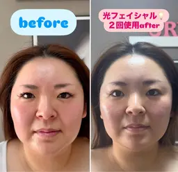 光フェイシャル