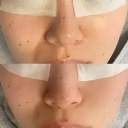 【乾燥が気になる方🍂】フェイシャルコース/モニター募集中.ᐟ.ᐟ