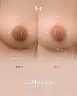 韓国No.1シェア【メラニン除去ケア】 バストトップ＊アフタークリーム1個(¥17,000)付き