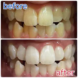 【当日限定✨】セルフホワイトニング体験メニュー！歯の黄ばみに！8分x3回で効果実感セルフで簡単本格ケア🥰
