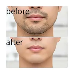 【MEN'S】ヒゲ ワックス×美容脱毛（ほほ～あご下）