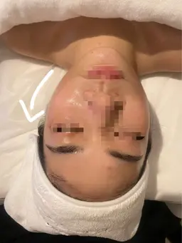 [人気NO.1小顔＆リフトアップ]ハイパーナイフ小顔+コルギ+石膏パック90分