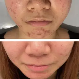 【気になるニキビ跡に】最新機種アクアダーマ×ニキビ跡アンプル＋ララピール🖌️