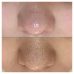 毛穴洗浄🫧高保湿リフトマスク付き¥12,100→6,600