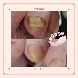 伸びない爪ケア