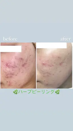ハーブピーリング🌿痛みなし剥離なしダウンタイムなし