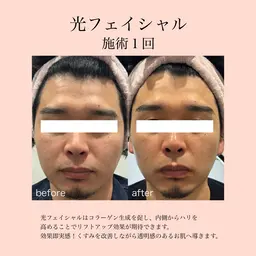 【リフトアップ】光フェイシャル