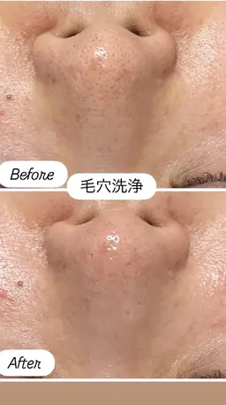 本日限定!毛穴洗浄1500円❗️❗️