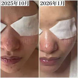 【人気No.1毛穴黒ずみ集中ケア】デコルテ＋ヘッドスパ付 90分 通常料金13,000円