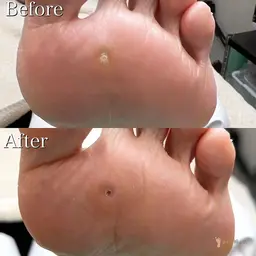 【魚の目ケア】朗報✨【🉐2回目以降もずっと"施術料が500円🉐】足裏ゴワゴワ痛​〜​い魚の目をキレイな足裏へ💁‍♀️