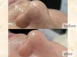 メンズOK◎【黒ずみ/毛穴/角質】スッキリお鼻毛穴洗浄！♪