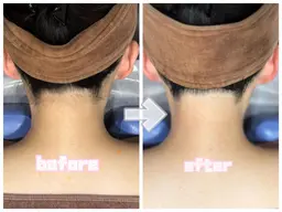 抜け落ち実感IPLうなじ脱毛🌙✨安心の実績40年✨初めての方大歓迎✨二段階シェービング付🌙✨ワックス・剃刀卒業🌙