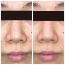 【毛穴開き・黒ずみ集中ケア】毛穴洗浄/選べるパックでつるん肌実感 30分 ¥7700→¥5500