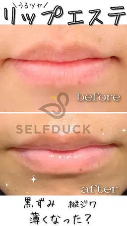 💋歯科衛生士の本格うるツヤリップエステ💋