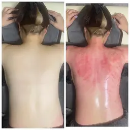 カッピング痩身　上半身25分