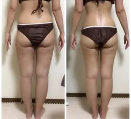 【人気No.1鬼痩せコース】よもぎ蒸し＋スリムレーザー30分(メンズOK)