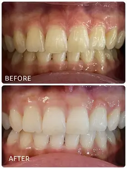 6日間限定💦５名限定‼️20分✖️6回コース🦷✨(現金払い)