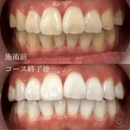 ※初回はジェルの注文のみです！【持続期間・白さにこだわるなら】歯科提携ジェルホワイトニング　美容ホワイトニングは当日可能