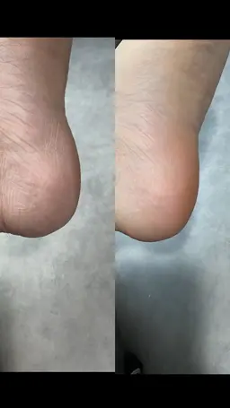 フット足裏角質ケア