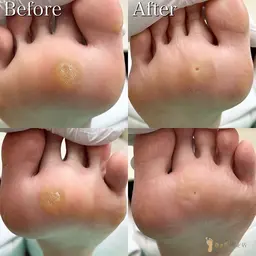 【足裏タコケア】足裏にできたゴワゴワ🌀角質もスベスベの足裏に✨是非お試しください💁‍♀️