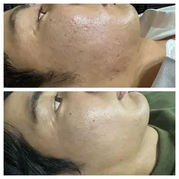 【とにかく肌を綺麗にしたい人ミニモ学割】ハーブピーリング+毛穴洗浄