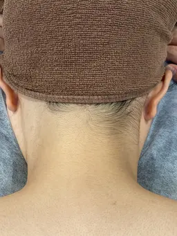 【メンズ&レディース】うなじ脱毛