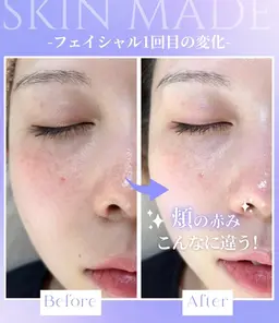 【原因別ニキビケア】繰り返しにくいなめらかな素肌🪽￥11,000→￥5,500