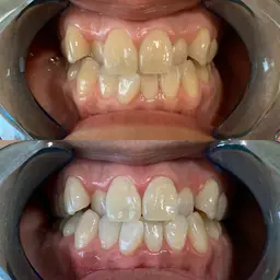 ホワイトニング🦷✨15分✖︎2回