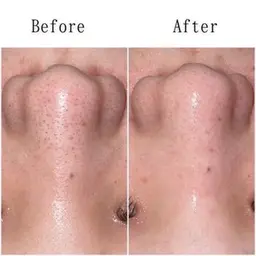 【初回限定】ハイドロ毛穴洗浄✨黒ずみ除去＆つるん肌体験　　　　　　　　　　　　　　　通常¥7000→¥3900